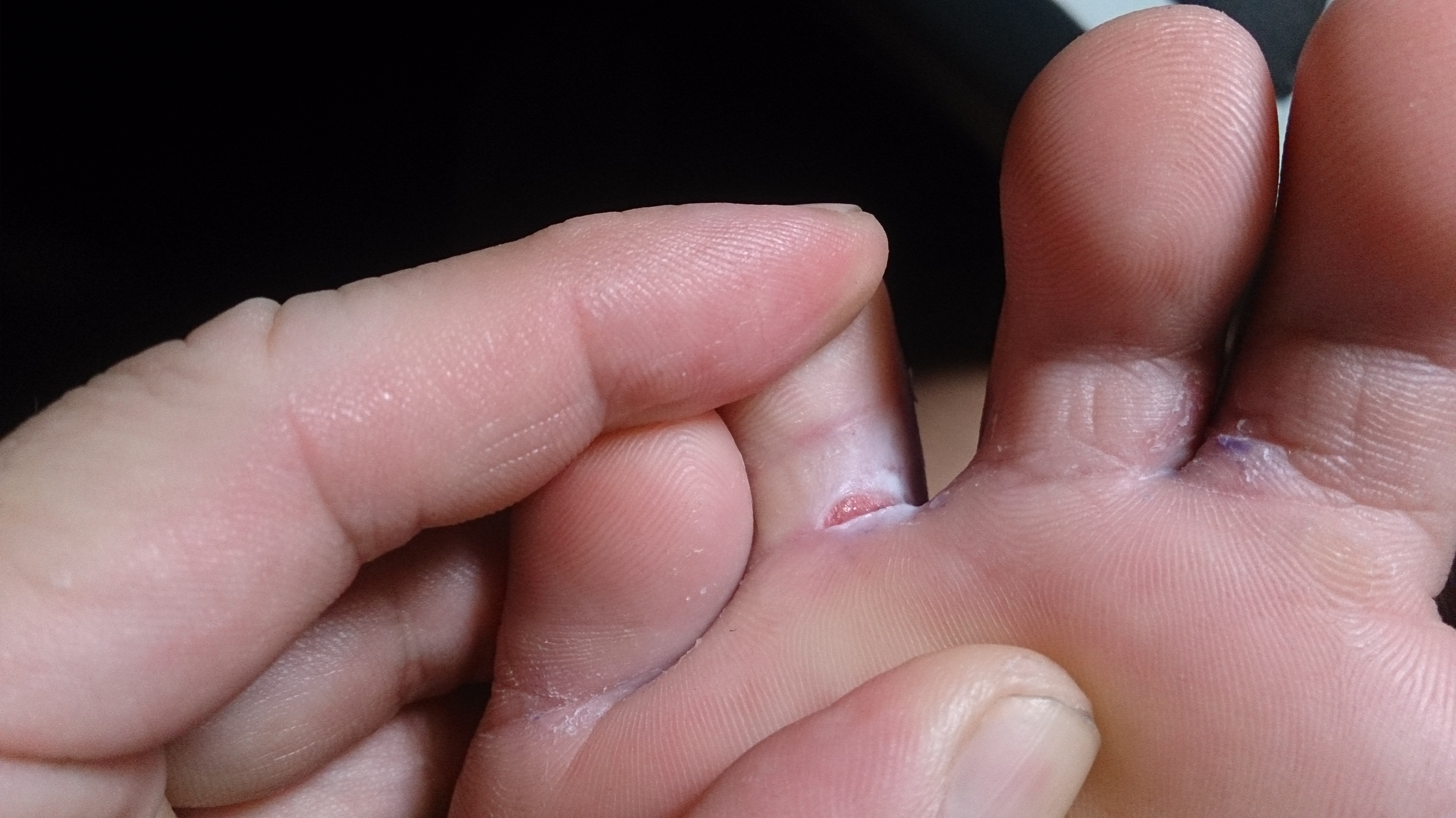 athletes foot under the foot 